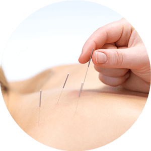 Akupunktur